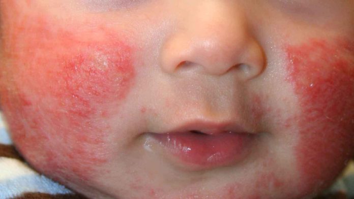 Gaza Children Face Severe Skin Disease Crisis Amid Ongoing Humanitarian Emergency