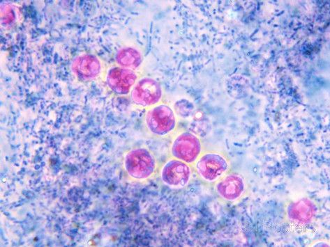 Sharp Rise In UK Cyclospora Cases Linked To Travel To Mexico